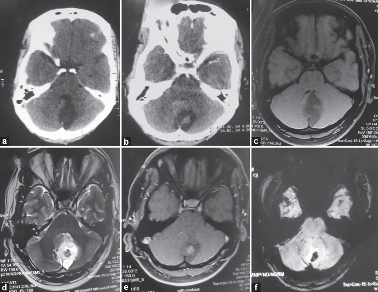 (a and b) Plain and contrast computed tomography, (c-f) magnetic resonance imaging images (c) T1-weighted image, (d) T2 weighated image, (e) T1 contrast, (f) susceptibility-weighted image