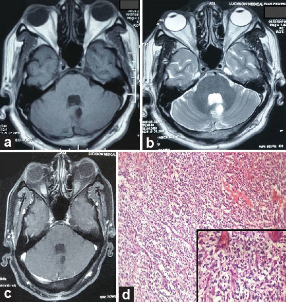 (a-c) Follow-up magnetic resonance imaging (a) T1-weighted image, (b) T2-weighted image, (c) T1 contrast, (d) histopathological examination ×100 (inset ×400)