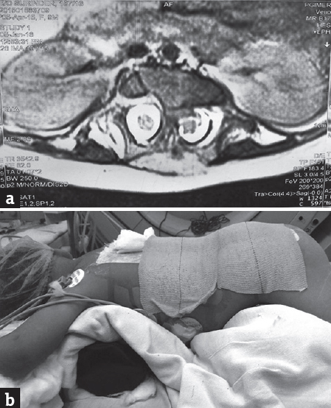 (a) Axial T2-weighted magnetic resonance imaging section through the bony spur showing thick bony spur splitting the cord into two halves. (b) Patient is in prone position (bolster below chest and abdomen is free)