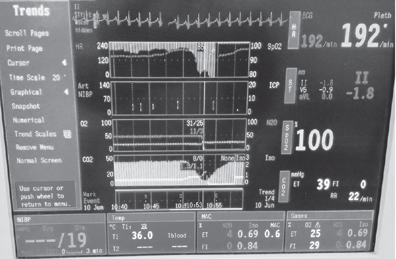 Trends of hemodynamics showing sudden fall in ETCO2 and restore after resuscitation