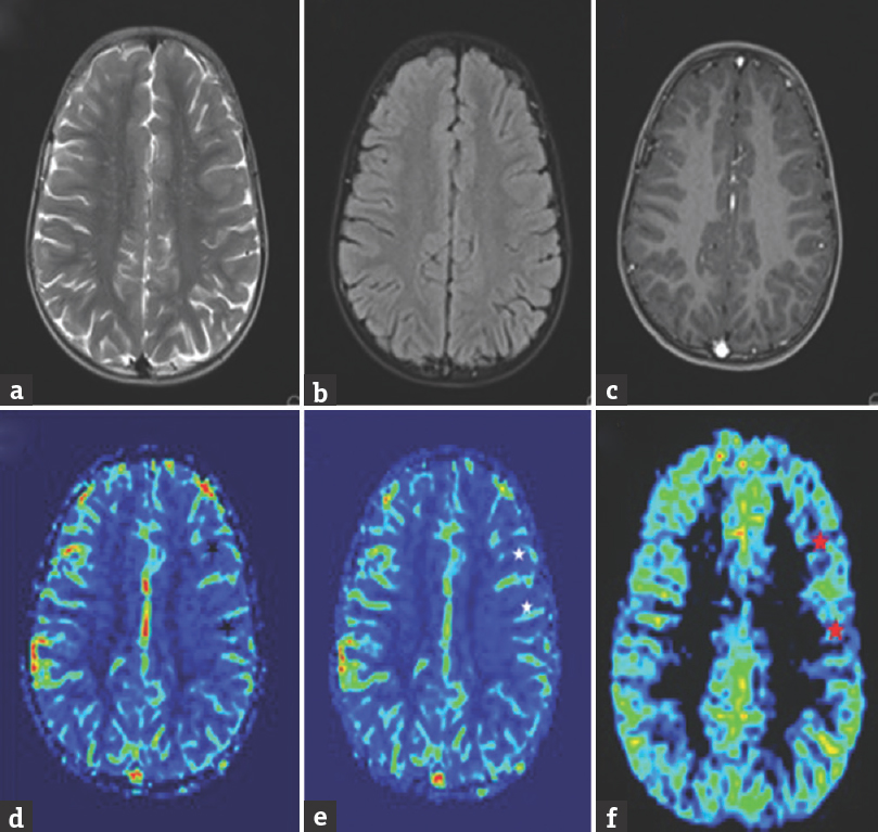 Magnetic resonance imaging of 11-year-old male child obtained 13 h after seizure onset showing no abnormality on axial T2 (a), fluid inversion recovery (b), postcontrast – T1 (c) while revealing hypoperfusion in left frontoparietal lobe on dynamic susceptibility contrast – cerebral blood volume ([d] black asterisk), dynamic susceptibility contrast – cerebral blood flow ([e] white asterisk) and arterial spin labeling ([f] red asterisk)