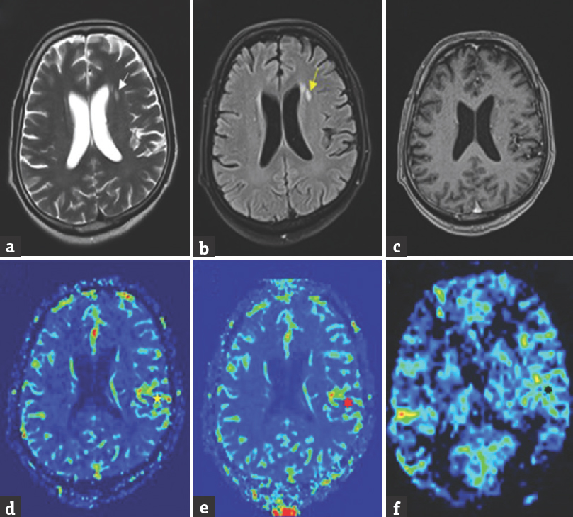 Magnetic resonance imaging of 57-year-old male child obtained 5 h after seizure onset showing insignificant T2 and fluid inversion recovery hyperintensity on axial T2 ([a] white arrow), fluid inversion recovery ([b] yellow arrow), post contrast – T1 (c) while revealing hyperperfusion in left frontoparietal lobe on dynamic susceptibility contrast – cerebral blood volume ([d] yellow asterisk), dynamic susceptibility contrast – cerebral blood flow ([e] red asterisk) and arterial spin labeling ([f] black asterisk)