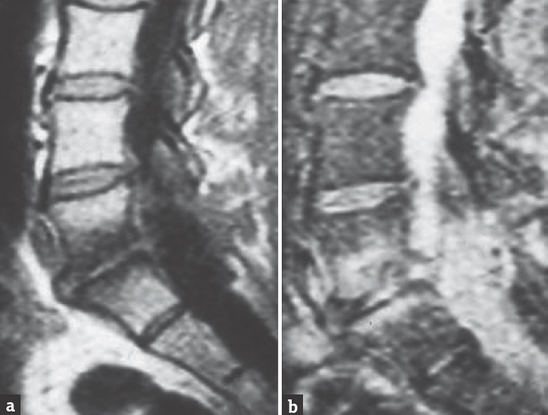 Magnetic resonance imaging T1(a) and T2-weighted (b) images showing L4–L5 spontaneous spondylodiscitis; Staphylococcus aureus