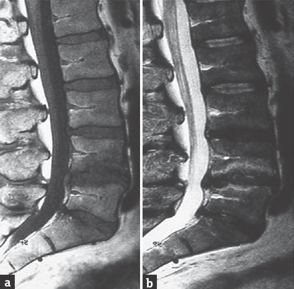 Magnetic resonance imaging T1(a) and T2-weighted (b) images showing L4–L5 spontaneous spondylodiscitis; Escherichia coli