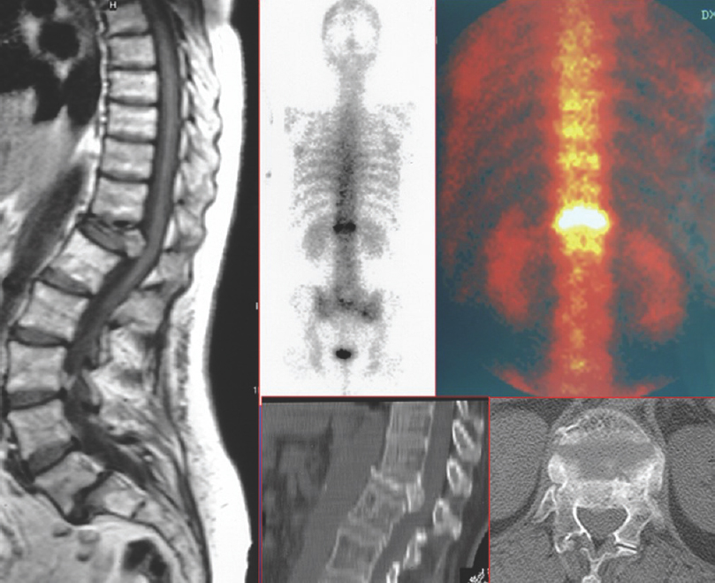 Magnetic resonance imaging, computed tomography scans and scintigraphy with gallium 67 in an HIV immunocompromised patient. T12–L1 spontaneous spondylodiscitis; Pseudomonas aeruginosa