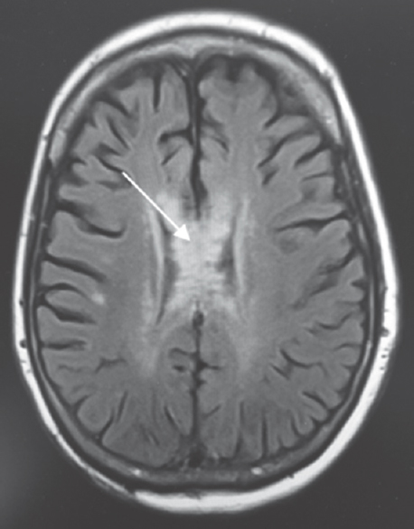 Fluid-attenuated inversion recovery sequence of magnetic resonance imaging. Fluid-attenuated inversion recovery changes are seen in the body, splenium, and genu of the corpus callosum (arrow)