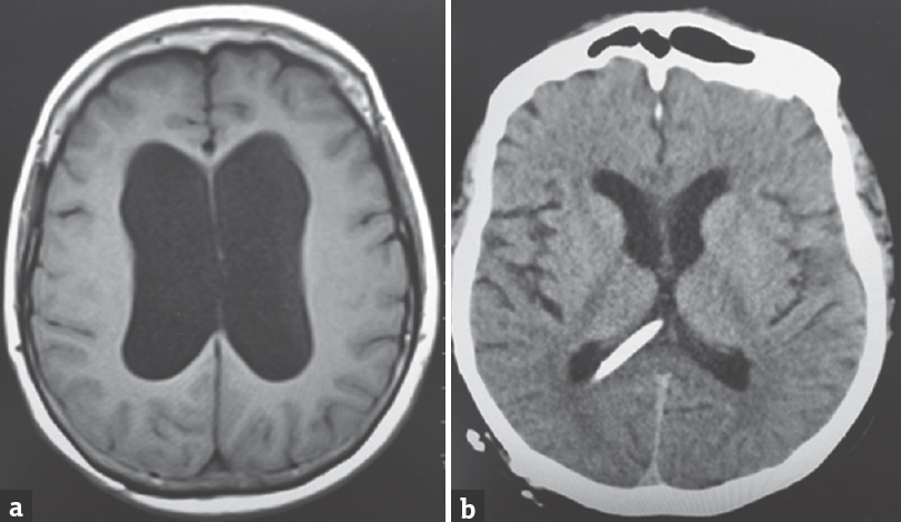 Initial magnetic resonance imaging of the brain axial T2 fluid-attenuated inversion recovery image showing the communicating hydrocephalus with thinning and effacement of the corpus callosum (a) computed tomography of the head axial cut postprocedure showing ventriculoperitoneal shunt tip and resolution of hydrocephalus (b)