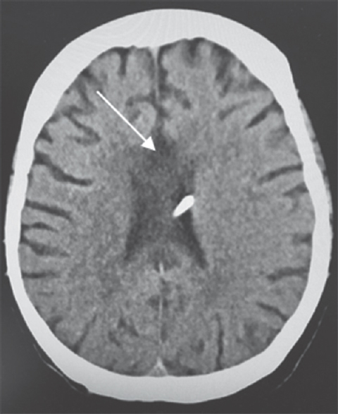 Computed tomography of the head. Follow-up computed tomography at 1 year shows hypodensity changes in the body, genu, and splenium of the corpus callosum (arrow)