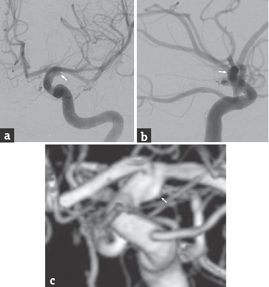 Cerebral angiography, (a) anteroposterior projection, (b) lateral projection, and (c) three-dimensional reconstruction of a left internal carotid artery injection, shows a blister aneurysm arising from the left supraclinoid internal carotid artery immediately distal to the origin of the anterior choroidal artery (arrow)