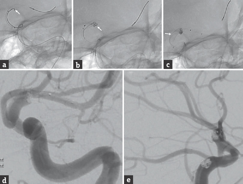 Unsubtracted fluoroscopy, anteroposterior projection, shows (a) a 2.75 mm × 12 mm Pipeline Flex Embolization Device was partially deployed with a microcatheter jailed in the aneurysm (arrow); (b) a 1.5 mm × 4 cm Target coil (arrow) was deployed into the aneurysm, and the first Pipeline Flex Embolization Device was fully deployed; (c) a second 1.5 mm × 2 cm Target coil was deployed into the aneurysm, and a second 3.25 mm × 10 mm Pipeline Flex Embolization Device (arrow) was deployed within the first Pipeline Flex Embolization Device in a telescoping configuration. Postembolization angiography (d) anteroposterior and (e) lateral projections of a left internal carotid artery injection, shows a stable coil construct and patency of the distal branch vessels