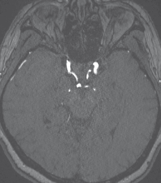 Magnetic resonance angiography performed at 15 months postembolization follow-up, axial view, shows complete obliteration of both aneurysms