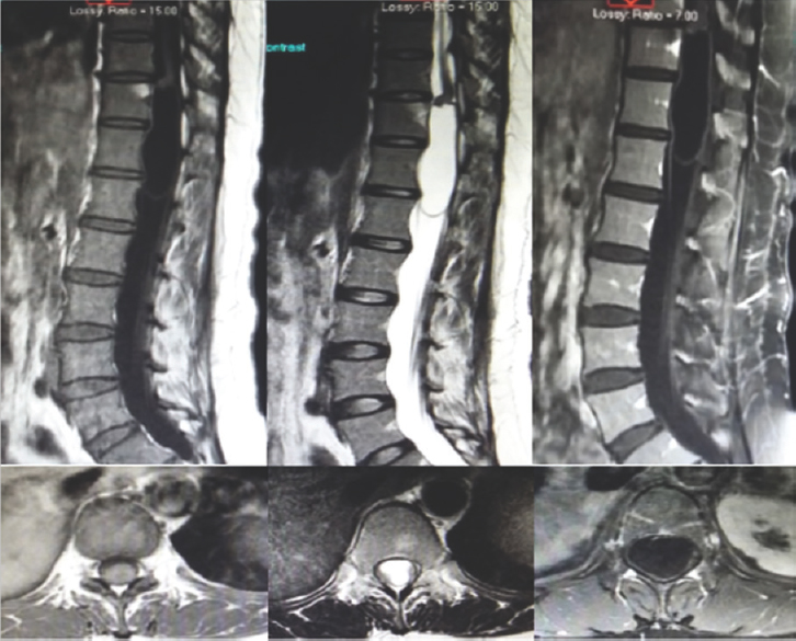 Preoperative T1-weighted image, T2 weighted image and Gadolinium (GAD) contrast sagittal and axial magnetic resonance imaging images of intradural extramedullary cerebrospinal fluid signal intensity mass lesion opposite D11, D12, and upper border of L1 vertebrae