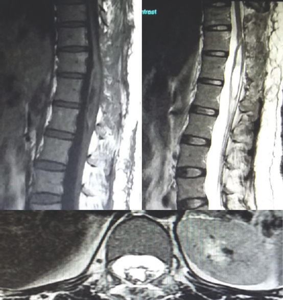 Two-week postoperative T1-weighted image, T2 weighted image sagittal and axial magnetic resonance imaging images showing significant reduction in size of lesion