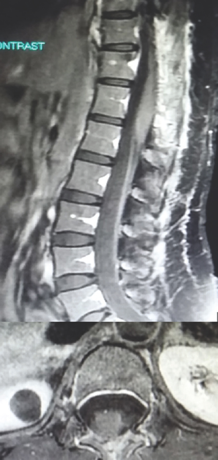 Five-month postoperative T1-weighted image sagittal and axial magnetic resonance imaging images