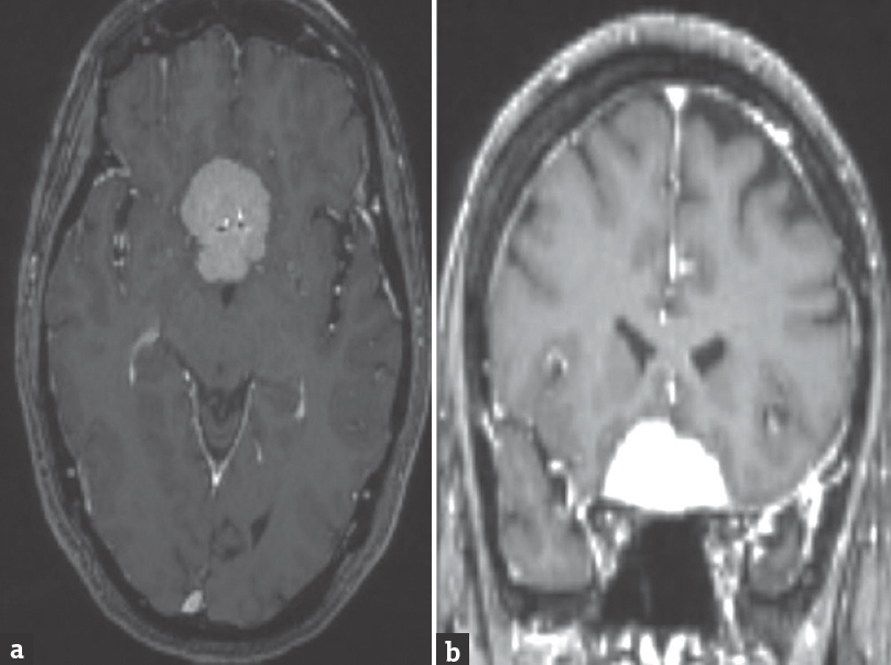 Axial (a) and coronal (b) images showing an enhancing suprasellar mass lesion suggestive of meningioma