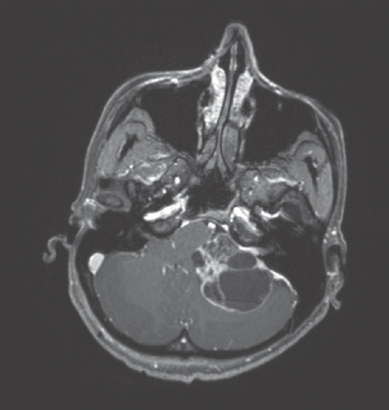 Magnetic resonance imaging brain axial T1-weighted contrast images showing a left cystic vestibular schwannoma