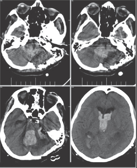 Postoperative computed tomography scan showing blood predominantly in the ventricles with a small operative-site hematoma