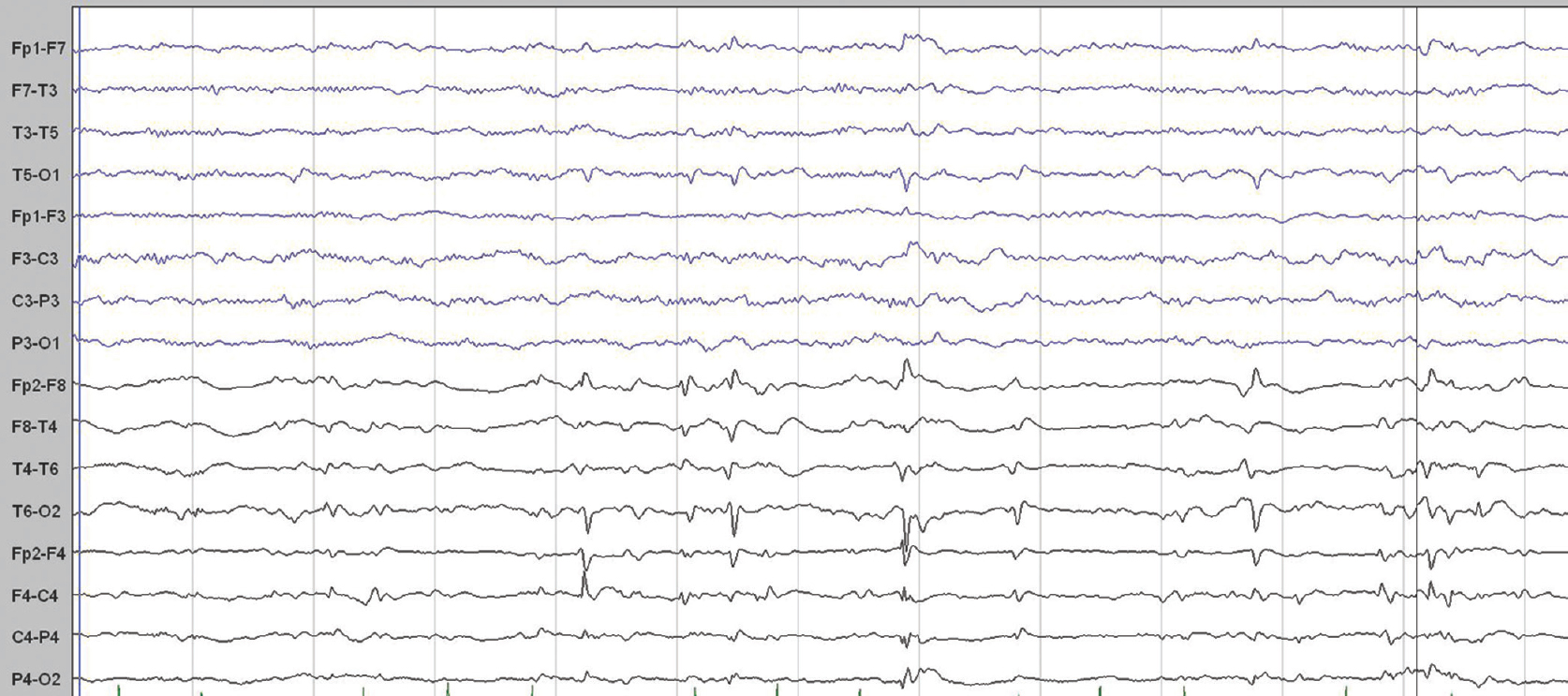 Electroencephalogram (bipolar longitudinal montage, sensitivity 7.5 mV/mm, low-frequency filter 1 Hz, high-frequency filter 70 Hz, notch 50 Hz, speed 30 mm/s) shows sharp wave discharges from the right frontal/anterior temporal region