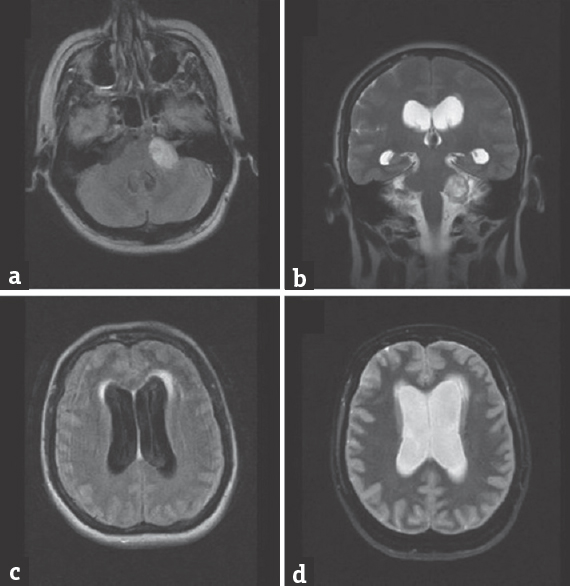 (a and b) Fluid-attenuated inversion recovery axial and T2-coronal magnetic resonance imaging images showing left cerebellopontine schwannoma without significant compression on fourth ventricle. (c and d) Fluid-attenuated inversion recovery and T2-axial magnetic resonance imaging images presenting enlargement of lateral ventricles with signs of subependymal effusions