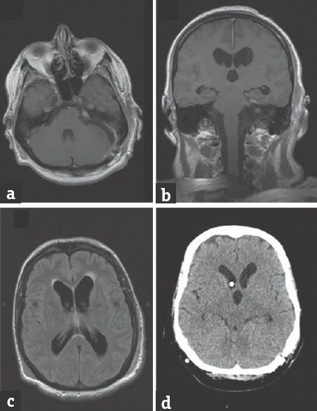 (a-c) Control magnetic resonance imaging after tumor removal, showing small tumor remnant in internal acoustic porus and persistence of ventricular enlargement. (d) Control after implanted a programmable ventriculoperitoneal shunt showing ventricular size reduction and appropriate position of proximal catheter