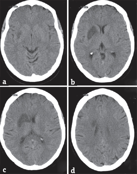 Multiple Inherited Thrombophilias In A Young Patient With 