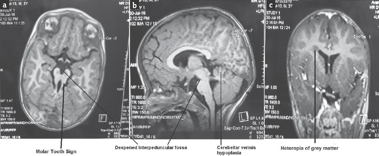 Magnetic resonance imaging brain showing molar tooth sign (a), deepened interpeduncular fossa, cerebellar vermis hypoplasia (b), and heterotopias of gray matter (c)