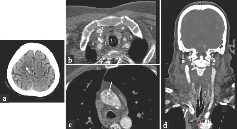 Computed tomography and computed tomography angiography. A right frontal hypodensity consistent with acute ischemic stroke is seen (a, arrow). Axial computed tomography angiography images show the central arterial catheter entering the right common carotid (b, arrow) and tip in the arch of the aorta (c, arrow). The coronal computed tomography angiography image shows the central arterial catheter in the right common carotid artery (d, arrow)