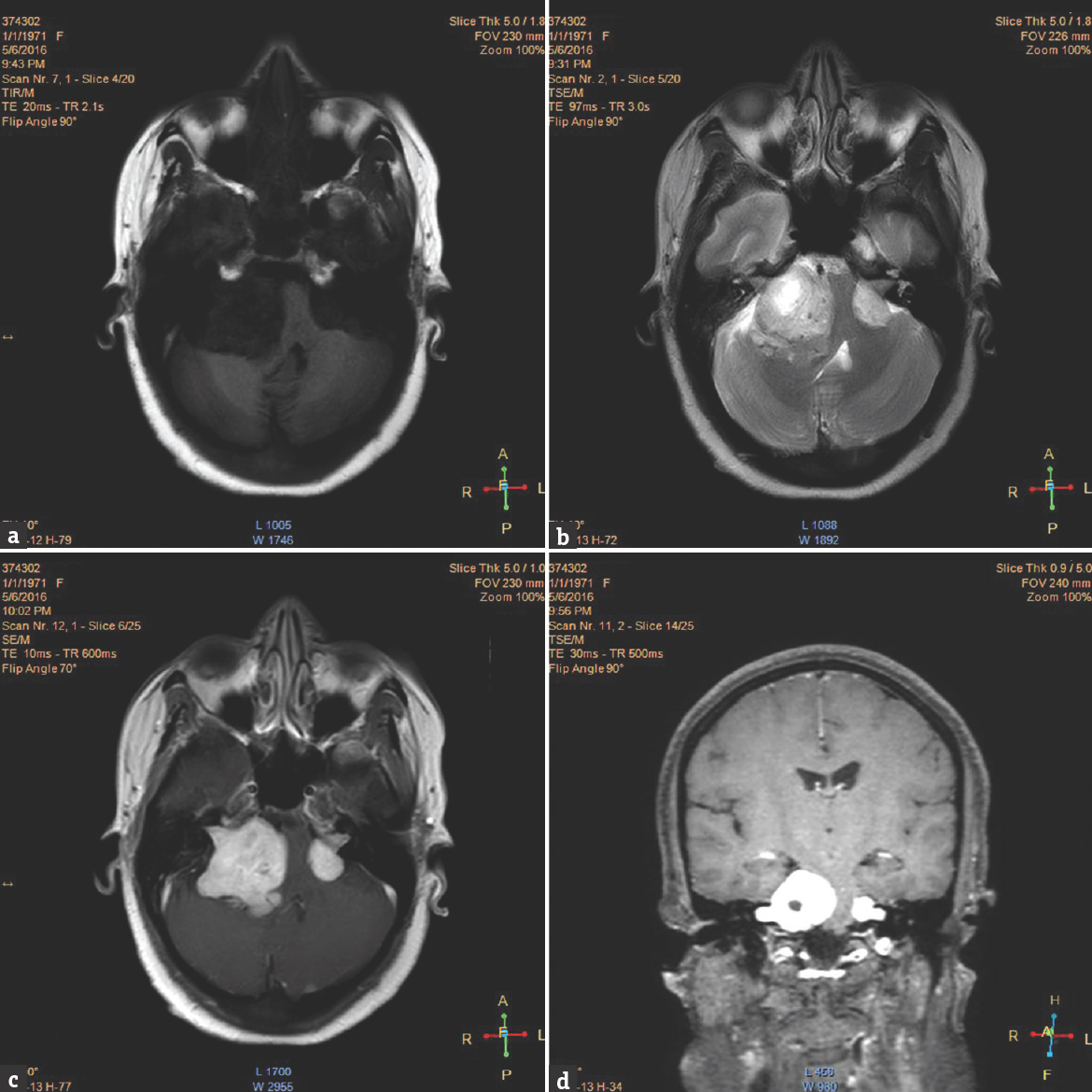 Magnetic resonance imaging brain (a) T1-weighted image showing hypointense tumor. (b) T2-weighted image showing hyperintense tumor. (c and d) Contrast image showing homogenously enhancing tumor in bilateral cerebellopontine angle