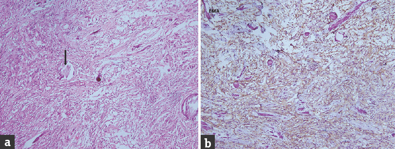 (a) Spindle cell tumor with hypo- and hypercellular areas suggestive of schwannoma. Verocay bodies (thin arrow) are seen (H and E, ×20). (b) Tumor is negative for epithelial membrane antigen