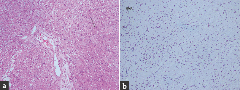 (a) Moderately cellular tumor with oval to spindle cells arranged in sheets and whorls suggestive of a meningioma. Psammoma bodies (bold arrow) are also seen (H and E, ×20). (b) Tumor is positive to epithelial membrane antigen