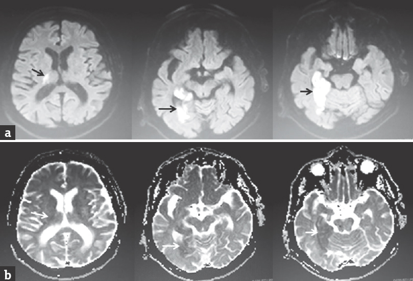 (a and b) Cranial magnetic resonance imaging showing high signal in the diffusion-weighted imaging sequences and low signal in ADC sequences in the diffusion restricted regions involving the lateral part of thalamus and occipitotemporal lobes (arrows). Of note, the regions corresponding to ventral posterolateral, ventral posteromedial, and centromedian nuclei of thalamus seem to be spared from ischemic injury