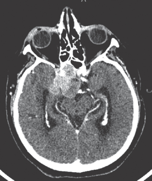 Brain computed tomography scan was carried out and revealed the presence of hyperdense mass lesion in sella with extrasellar spread