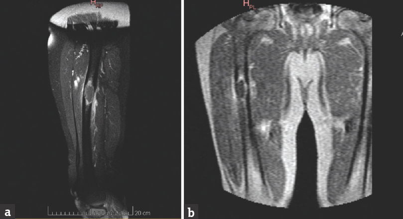 (a and b) Magnetic resonance imaging of the muscle was present, with diaphyseal metastatic lesion