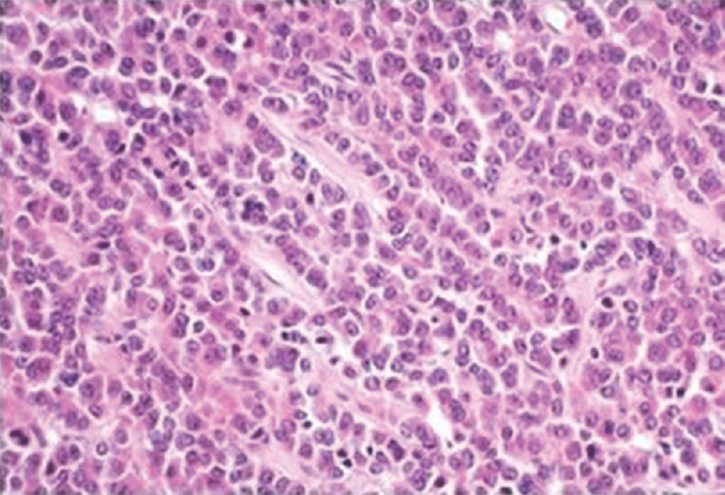 Biopsy was suggestive of metastatic deposit of prolactin secreting pituitary carcinoma