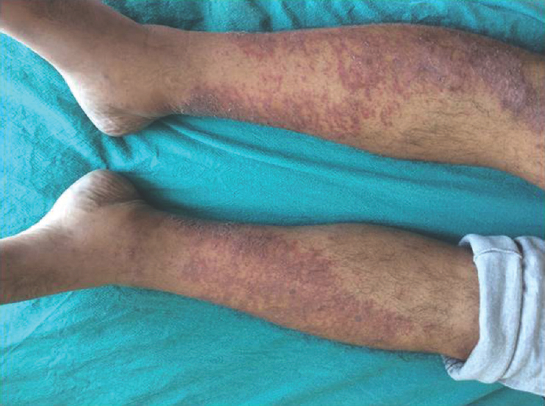 Erythematous patch in a patient with vasculitic neuropathy
