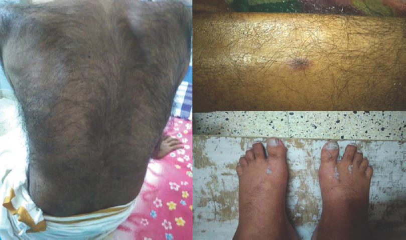 Hypertrichosis, telangiectasia, edema legs with psoriasiform skin changes (This is typical of poems syndrome)