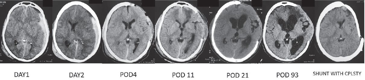 Timeline of events on a computed tomography scan of a typical patient who developed ventriculomegaly following a malignant middle cerebral artery infarct and underwent aspiration with cranioplasty. POD: Postoperative day, Asp + Cplsty: Aspiration with cranioplasty