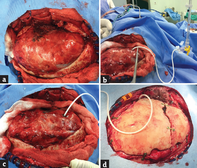 Intraoperative images of a patient with acute subdural hematoma and coronal sutural diastasis 3 months after decompressive craniectomy. Patient is undergoing aspiration with cranioplasty. (a) The mildly tense brain is visualized after raising of skin flap. (b) Intracranial pressure being measured after cannulation ventricles at the Paine's point. (c) The brain becoming very lax after sufficient amount of cerebrospinal fluid is let off. (d) The bone pieces being anchored at the craniectomy site with plate and screws