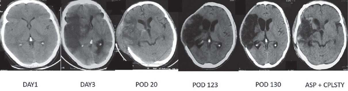 Timeline of events on a computed tomography scan of a typical patient who developed ventriculomegaly following acute subdural hematoma and underwent Ventriculoperitoneal shunt. POD: Postoperative day, Cplsty: Cranioplasty