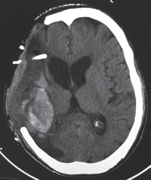 Computed tomography brain plain showing intracerebral hematoma along the tract on the posterior parietal region. The external ventricular drain has been pulled out in transit to the computed tomography scan which was reinserted later