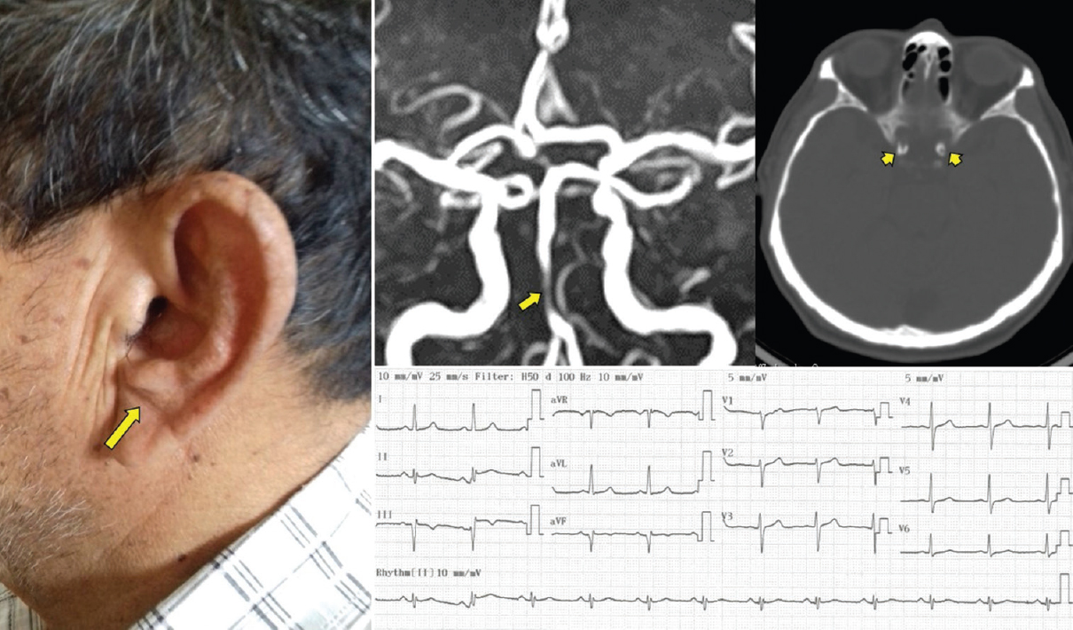 Photograph of the patient showing a diagonal earlobe crease (large arrow), magnetic resonance angiography showing severe segmental stenosis of the basilar artery (short arrow), computed tomography showing severe calcification of both carotid siphons (arrowhead), and electrocardiogram showing an old inferior myocardial infarction