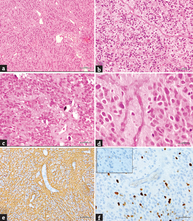 (a-d) A cellular glial neoplasm with perivascular rosettes (H and E; a: ×100, b and c: ×200; d: ×400; Note c-in addition shows small specks of calcification, (e) glial fibrillary acidic protein stain showing positive stained neoplastic glial cells with perivascular accentuation (GFAP: ×200), (f) MIB-1 IHC showing significantly increased labeling index (×200); Inset: shows epithelial membrane antigen stain with paranuclear dot positive staining (×400)