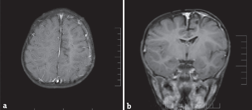 (a and b) Magnetic resonance imaging postcontrast imaging shows no residual lesion at operative site at 1-year follow-up