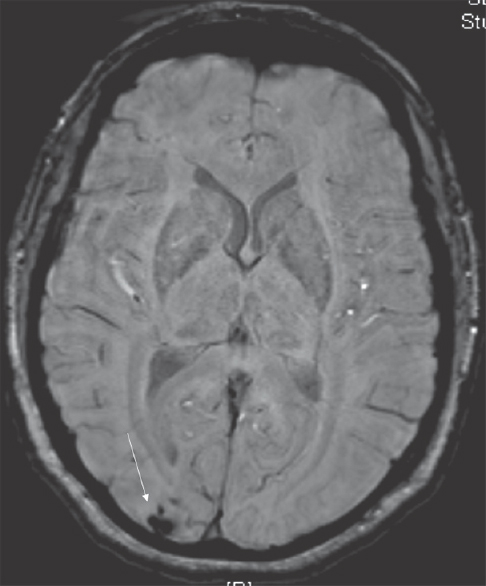 Magnetic resonance imaging on admission. Magnetic resonance imaging shows blooming artifact (arrow) on the susceptible weighted imaging