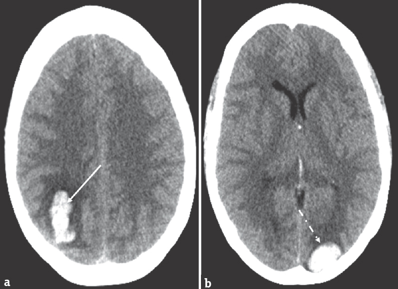 Computed tomography of the head after dihydroergotamine. Computed tomography shows right parietal hemorrhage (a, solid arrow) and left parieto-occipital hemorrhage (b, dashed arrow)