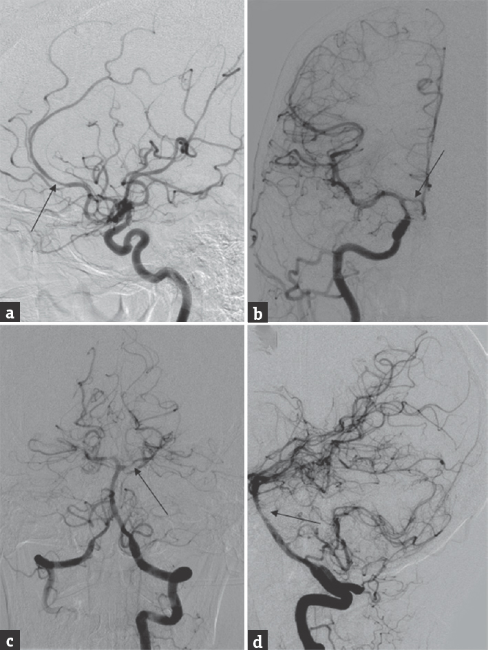 Digital subtraction angiography. Digital subtraction angiography showing diffuse vasculopathy in the anterior circulation (a and b, arrows) and posterior circulation (c and d, arrows)