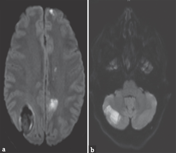 Magnetic resonance imaging. Magnetic resonance imaging showing hyperintensity on diffusion-weighted sequence in the anterior circulation (a) and in the cerebellum (b)