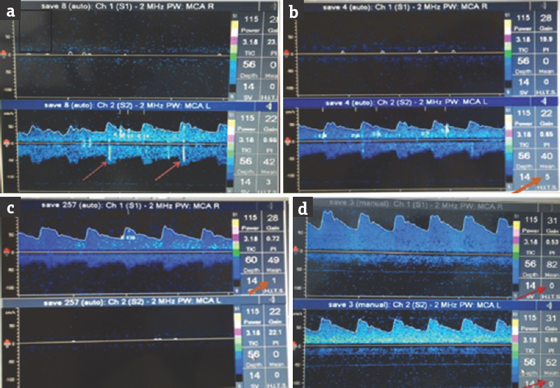 Transcranial Doppler emboli monitoring done 2 h after Definity contrast showing artifactual embolic hits in the left middle cerebral artery (a and b) and right middle cerebral artery (c) distribution. Arrows showing embolic hits as well as the number of embolic hits in a-c. Repeat transcranial Doppler emboli monitoring after 4 h (d) does not show any embolic hit (arrows)