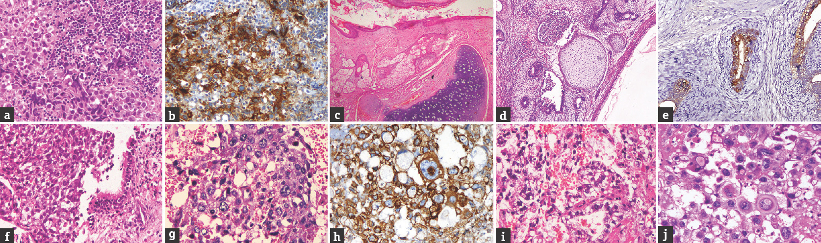 Montage representing microphotographs of the various Germ Cell Tumors. (a) Germinoma showing sheets of large cells with clear cytoplasm and prominent nucleolus in some cells and intervening lymphocytic infiltrates. (b) Germinoma cells show cytoplasmic staining for PLAP. (c) Mature teratoma composed of mature epidermal, dermal and cartilaginous elements. (d) Immature teratoma- showing immature glandular structures dispersed on a embryonal mesenchymal stroma containing foci of immature cartilage. (e) Immature glands staining positively for α feto protein. (f) Mixed GCT- showing germinoma (left half of panel) and teratoma (right half of panel). (g) Embryonal carcinoma-composed of large epithelial cells arranged in sheets and with macronuclei and brisk mitosis. (h) the cells stain positively for cytokeratin. (i) Yolk sac tumor showing ill-formed Schiller Duval body. (J) Choriocarcinoma– showing cytotrophoblast and syncitiotrophoblastic cells [All images are original magnification x160]