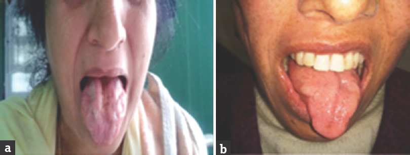 (a and b) Both patients were having bulbar-onset motor neuron disease showing atrophy of the tongue